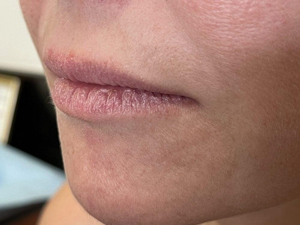 Lip Fillers Before & After Image