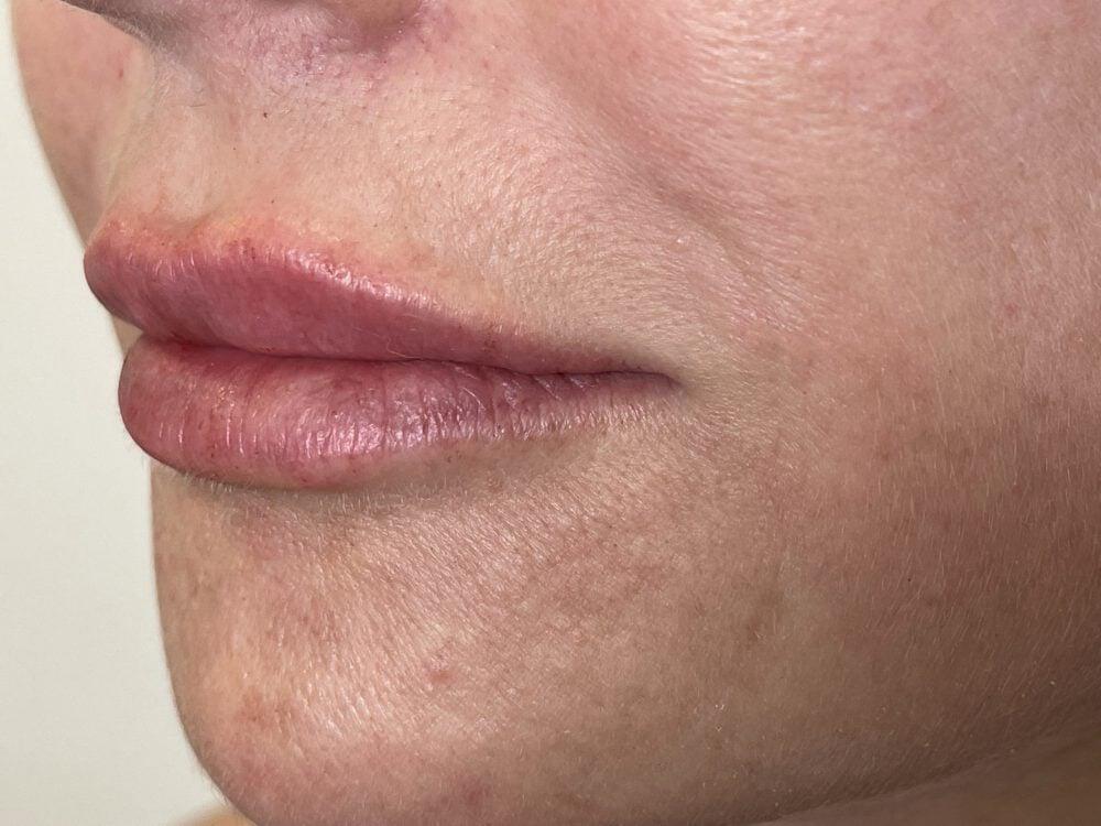 Lip Fillers Before & After Image