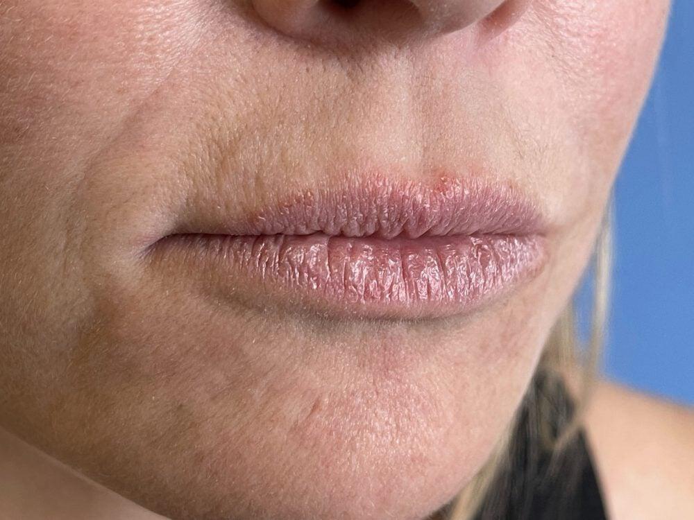 Lip Fillers Before & After Image