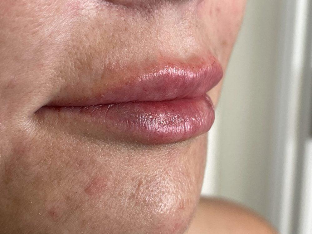 Lip Fillers Before & After Image